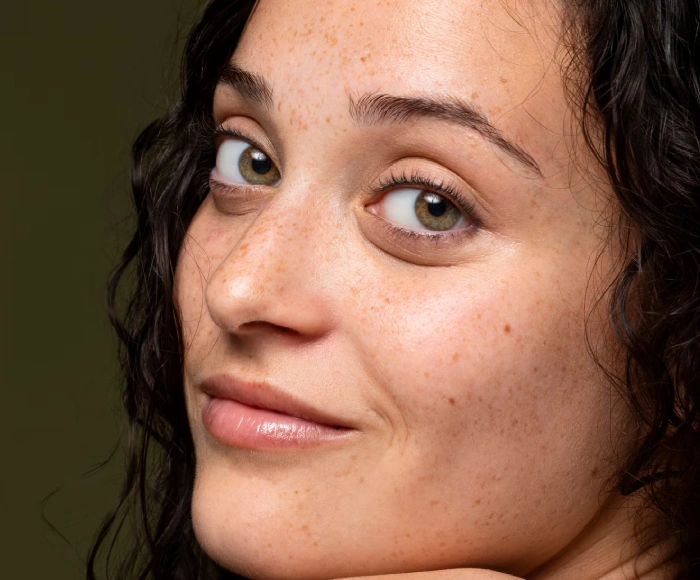 Pigmentation Treatment in Hyderabad