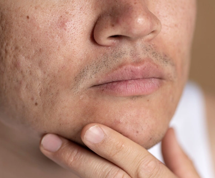 Acne Scar Treatment in Hyderabad