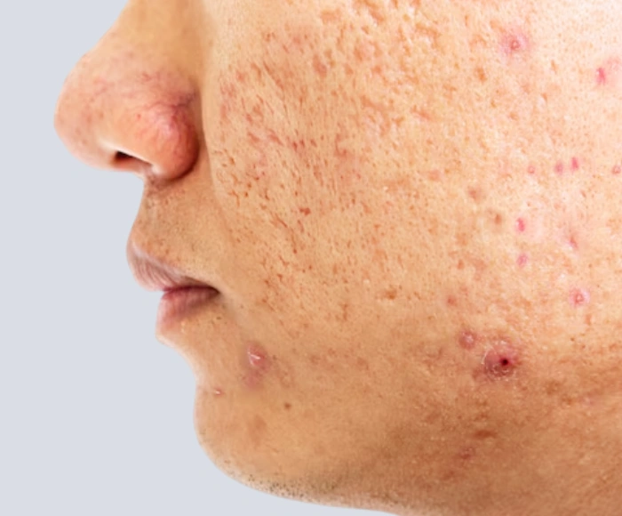 How to Remove Acne Scars Permanently: Top Treatments Compared