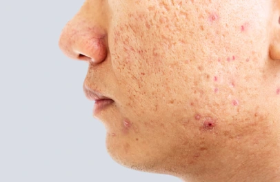 How to Remove Acne Scars Permanently: Top Treatments Compared