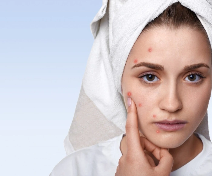Acne Treatment in Hyderabad
