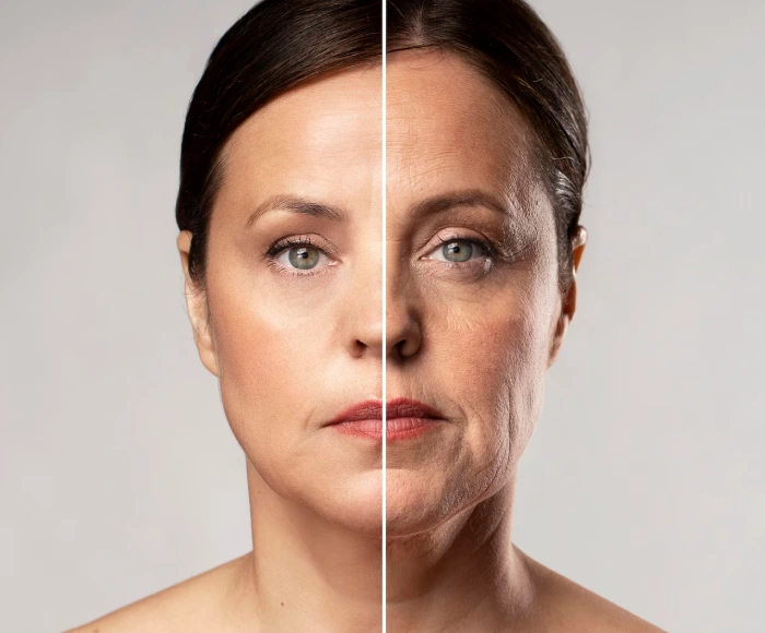 Anti-Wrinkle Injection Treatment in Hyderabad