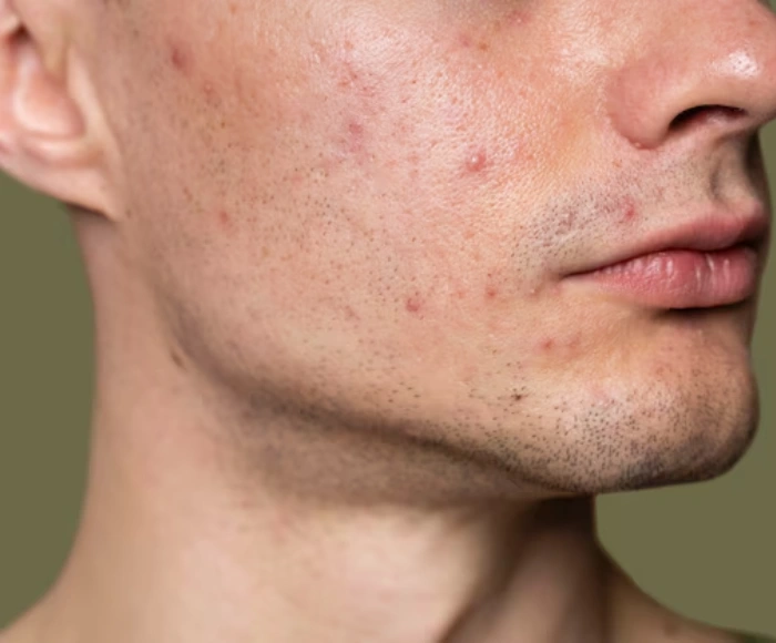 How to Treat Acne Fast: Dermatologist-Approved Methods