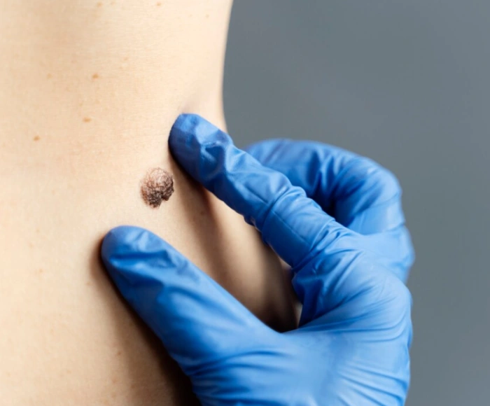 Mole Removal Treatment in Hyderabad