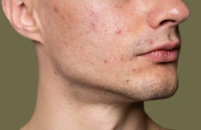 How to Treat Acne Fast: Dermatologist-Approved Methods