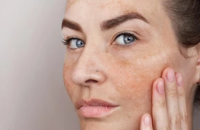 How to Remove Pigmentation from the Face Permanently?