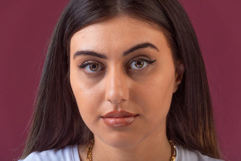 Dark Circles Treatment in Hyderabad