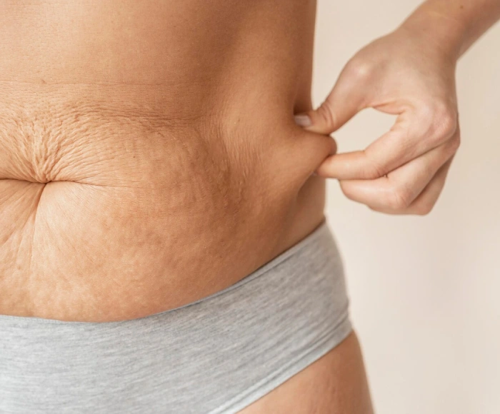 Stretch Mark Treatment in Hyderabad