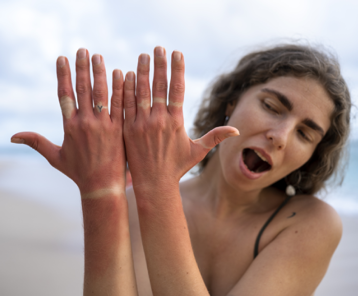 How to Remove Sun Tan This Summer? Dermatologist-Approved Tips