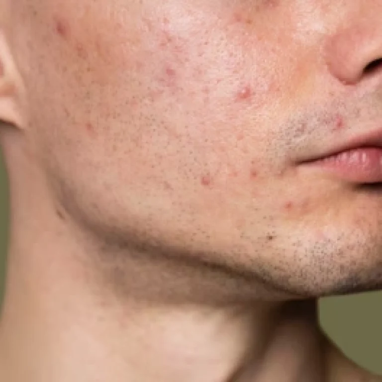 How to Treat Acne Fast: Dermatologist-Approved Methods